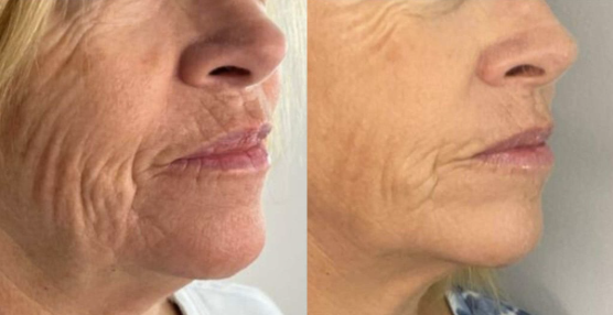 Före och efter Microneedling, verklig kund hos Beauty Clinic for Queens & Kings