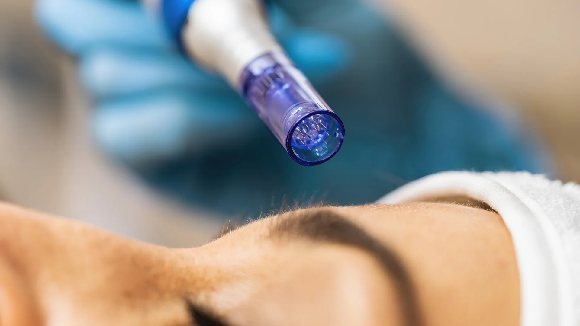 Microneedling-behandling med dermapen hos Beauty Clinic for Queens & Kings